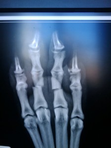X-ray of dog with two broken toes. Sled dogs have broken their toes racing in the Iditarod. Photo attributed to TedRheingold on flickr